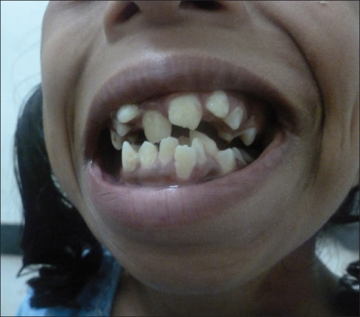 Descripción: Clinical examination revealed 7-mm probing depths, circumferentially around a mandibular implant, bleeding on probing, and the presence of exudate and gingival inflammatory edema