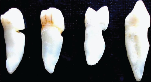 Descripción: Clinical examination revealed 7-mm probing depths, circumferentially around a mandibular implant, bleeding on probing, and the presence of exudate and gingival inflammatory edema