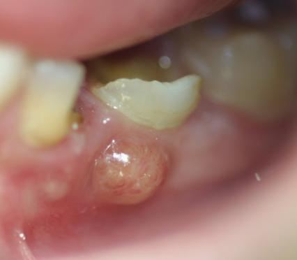 Descripción: Clinical examination revealed 7-mm probing depths, circumferentially around a mandibular implant, bleeding on probing, and the presence of exudate and gingival inflammatory edema