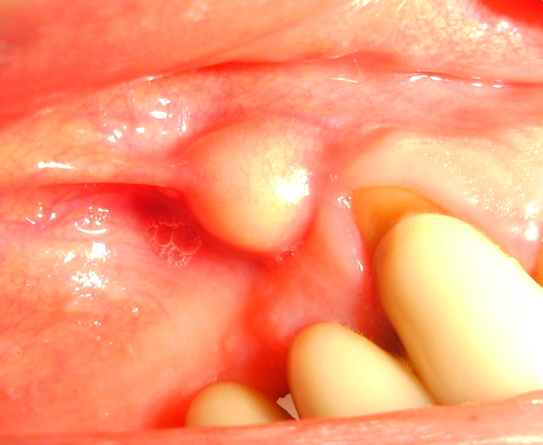 Descripción: Clinical examination revealed 7-mm probing depths, circumferentially around a mandibular implant, bleeding on probing, and the presence of exudate and gingival inflammatory edema