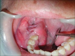 Descripción: Clinical examination revealed 7-mm probing depths, circumferentially around a mandibular implant, bleeding on probing, and the presence of exudate and gingival inflammatory edema