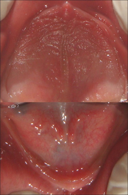 Descripción: Clinical examination revealed 7-mm probing depths, circumferentially around a mandibular implant, bleeding on probing, and the presence of exudate and gingival inflammatory edema