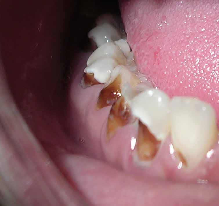 Descripción: Clinical examination revealed 7-mm probing depths, circumferentially around a mandibular implant, bleeding on probing, and the presence of exudate and gingival inflammatory edema