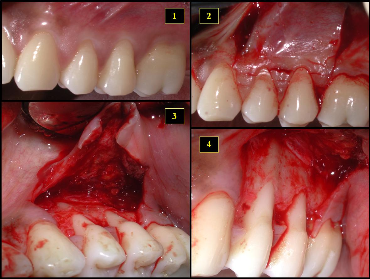 Descripción: Clinical examination revealed 7-mm probing depths, circumferentially around a mandibular implant, bleeding on probing, and the presence of exudate and gingival inflammatory edema