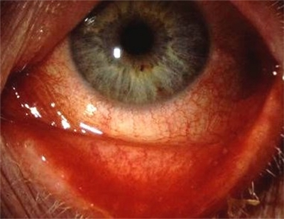 Descripción: Clinical examination revealed 7-mm probing depths, circumferentially around a mandibular implant, bleeding on probing, and the presence of exudate and gingival inflammatory edema