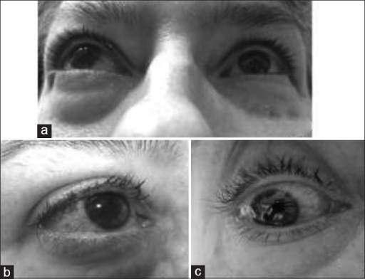 Descripción: Clinical examination revealed 7-mm probing depths, circumferentially around a mandibular implant, bleeding on probing, and the presence of exudate and gingival inflammatory edema