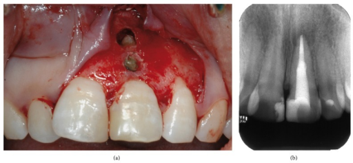 Descripción: Clinical examination revealed 7-mm probing depths, circumferentially around a mandibular implant, bleeding on probing, and the presence of exudate and gingival inflammatory edema