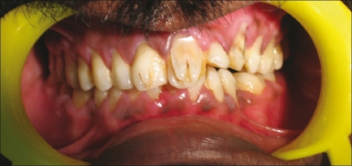 Descripción: Clinical examination revealed 7-mm probing depths, circumferentially around a mandibular implant, bleeding on probing, and the presence of exudate and gingival inflammatory edema