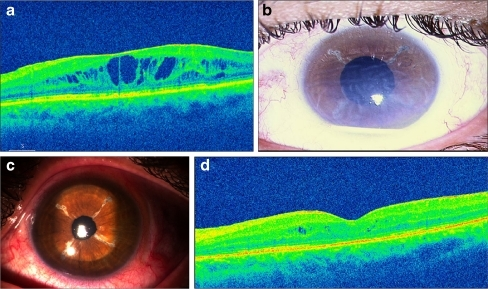 Descripción: Clinical examination revealed 7-mm probing depths, circumferentially around a mandibular implant, bleeding on probing, and the presence of exudate and gingival inflammatory edema