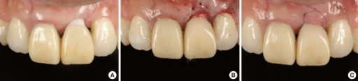 Descripción: Clinical examination revealed 7-mm probing depths, circumferentially around a mandibular implant, bleeding on probing, and the presence of exudate and gingival inflammatory edema