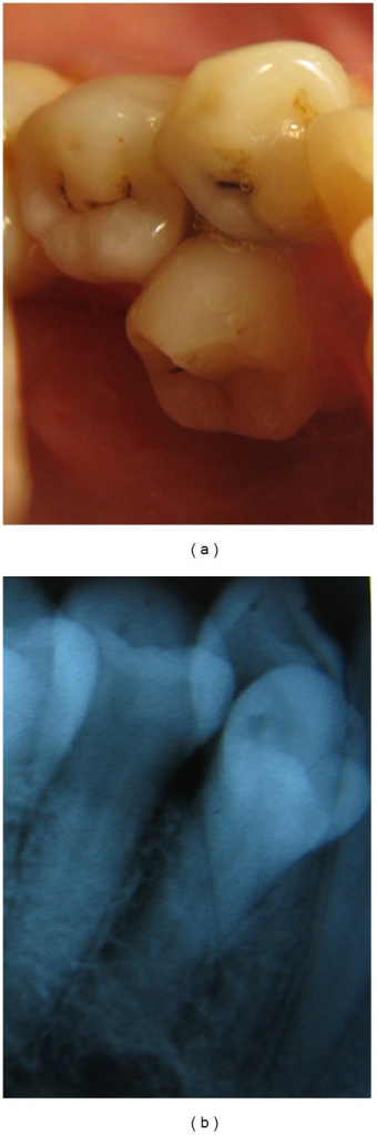 Descripción: Clinical examination revealed 7-mm probing depths, circumferentially around a mandibular implant, bleeding on probing, and the presence of exudate and gingival inflammatory edema