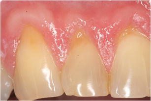 Descripción: Clinical examination revealed 7-mm probing depths, circumferentially around a mandibular implant, bleeding on probing, and the presence of exudate and gingival inflammatory edema