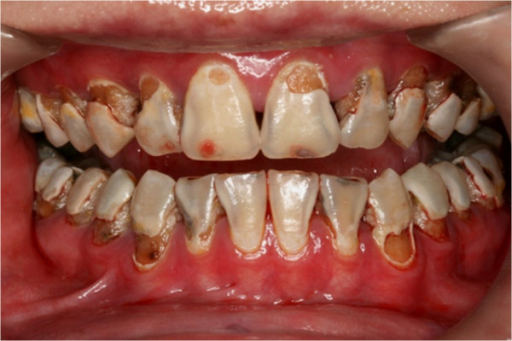 Descripción: Clinical examination revealed 7-mm probing depths, circumferentially around a mandibular implant, bleeding on probing, and the presence of exudate and gingival inflammatory edema