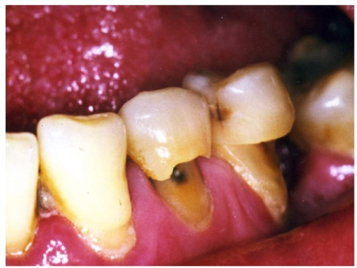 Descripción: Clinical examination revealed 7-mm probing depths, circumferentially around a mandibular implant, bleeding on probing, and the presence of exudate and gingival inflammatory edema