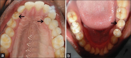 Descripción: Clinical examination revealed 7-mm probing depths, circumferentially around a mandibular implant, bleeding on probing, and the presence of exudate and gingival inflammatory edema