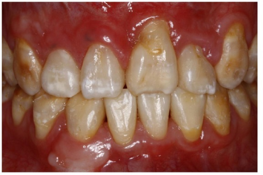 Descripción: Clinical examination revealed 7-mm probing depths, circumferentially around a mandibular implant, bleeding on probing, and the presence of exudate and gingival inflammatory edema