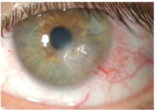 Descripción: Clinical examination revealed 7-mm probing depths, circumferentially around a mandibular implant, bleeding on probing, and the presence of exudate and gingival inflammatory edema