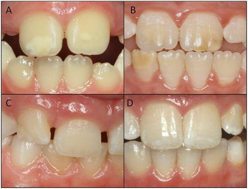 Descripción: Clinical examination revealed 7-mm probing depths, circumferentially around a mandibular implant, bleeding on probing, and the presence of exudate and gingival inflammatory edema