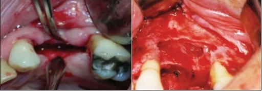 Descripción: Clinical examination revealed 7-mm probing depths, circumferentially around a mandibular implant, bleeding on probing, and the presence of exudate and gingival inflammatory edema