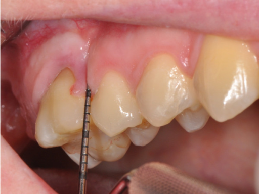 Descripción: Clinical examination revealed 7-mm probing depths, circumferentially around a mandibular implant, bleeding on probing, and the presence of exudate and gingival inflammatory edema