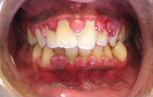 Descripción: Clinical examination revealed 7-mm probing depths, circumferentially around a mandibular implant, bleeding on probing, and the presence of exudate and gingival inflammatory edema