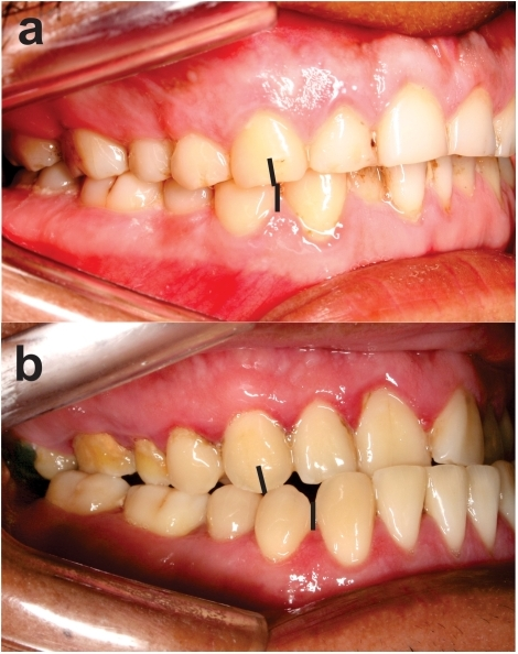 Descripción: Clinical examination revealed 7-mm probing depths, circumferentially around a mandibular implant, bleeding on probing, and the presence of exudate and gingival inflammatory edema