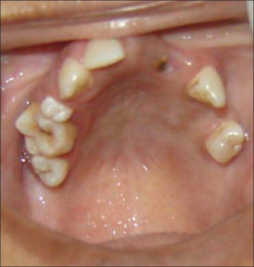 Descripción: Clinical examination revealed 7-mm probing depths, circumferentially around a mandibular implant, bleeding on probing, and the presence of exudate and gingival inflammatory edema