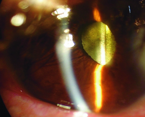 Descripción: Clinical examination revealed 7-mm probing depths, circumferentially around a mandibular implant, bleeding on probing, and the presence of exudate and gingival inflammatory edema