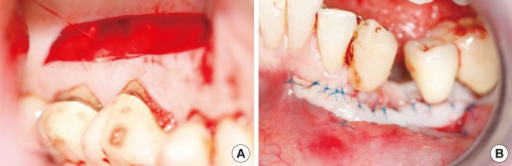 Descripción: Clinical examination revealed 7-mm probing depths, circumferentially around a mandibular implant, bleeding on probing, and the presence of exudate and gingival inflammatory edema