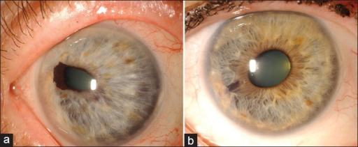 Descripción: Clinical examination revealed 7-mm probing depths, circumferentially around a mandibular implant, bleeding on probing, and the presence of exudate and gingival inflammatory edema