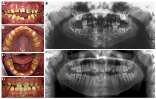 Descripción: Clinical examination revealed 7-mm probing depths, circumferentially around a mandibular implant, bleeding on probing, and the presence of exudate and gingival inflammatory edema