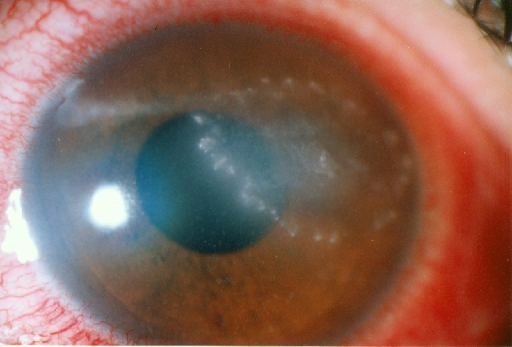 Descripción: Clinical examination revealed 7-mm probing depths, circumferentially around a mandibular implant, bleeding on probing, and the presence of exudate and gingival inflammatory edema