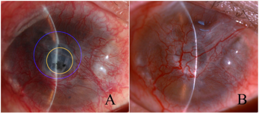 Descripción: Clinical examination revealed 7-mm probing depths, circumferentially around a mandibular implant, bleeding on probing, and the presence of exudate and gingival inflammatory edema