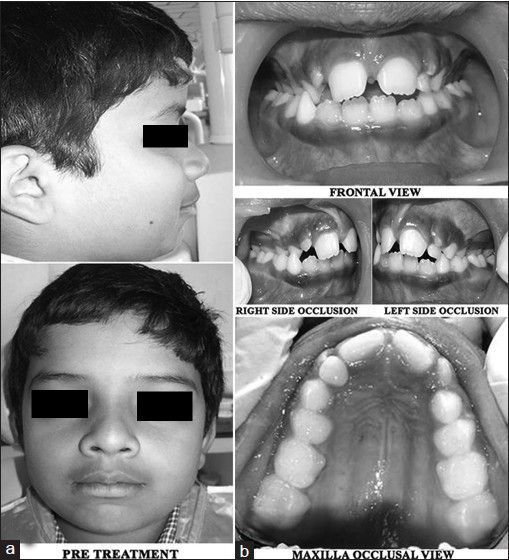 Descripción: Clinical examination revealed 7-mm probing depths, circumferentially around a mandibular implant, bleeding on probing, and the presence of exudate and gingival inflammatory edema