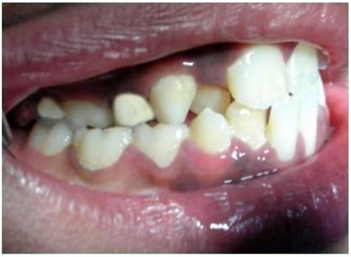 Descripción: Clinical examination revealed 7-mm probing depths, circumferentially around a mandibular implant, bleeding on probing, and the presence of exudate and gingival inflammatory edema