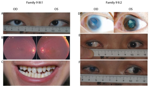 Descripción: Clinical examination revealed 7-mm probing depths, circumferentially around a mandibular implant, bleeding on probing, and the presence of exudate and gingival inflammatory edema