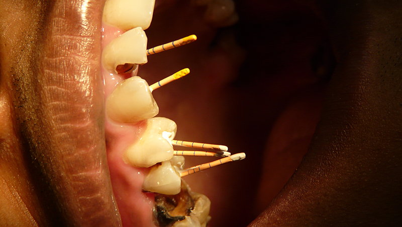 Descripción: Clinical examination revealed 7-mm probing depths, circumferentially around a mandibular implant, bleeding on probing, and the presence of exudate and gingival inflammatory edema