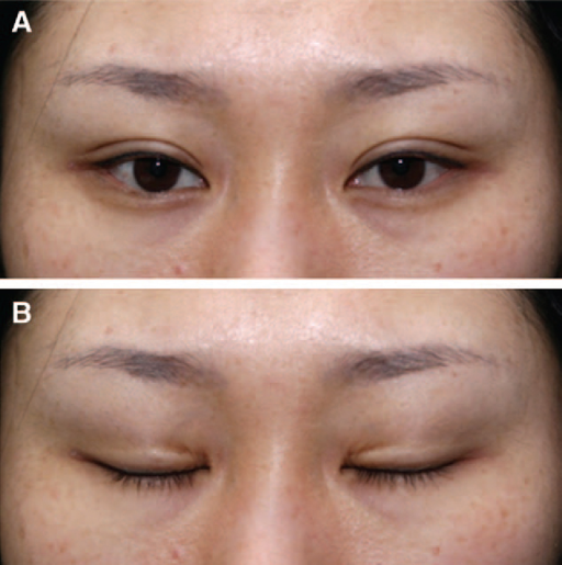 Descripción: Clinical examination revealed 7-mm probing depths, circumferentially around a mandibular implant, bleeding on probing, and the presence of exudate and gingival inflammatory edema