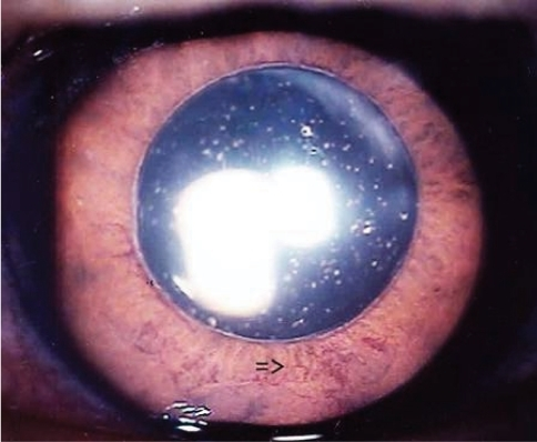 Descripción: Clinical examination revealed 7-mm probing depths, circumferentially around a mandibular implant, bleeding on probing, and the presence of exudate and gingival inflammatory edema