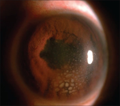 Descripción: Clinical examination revealed 7-mm probing depths, circumferentially around a mandibular implant, bleeding on probing, and the presence of exudate and gingival inflammatory edema