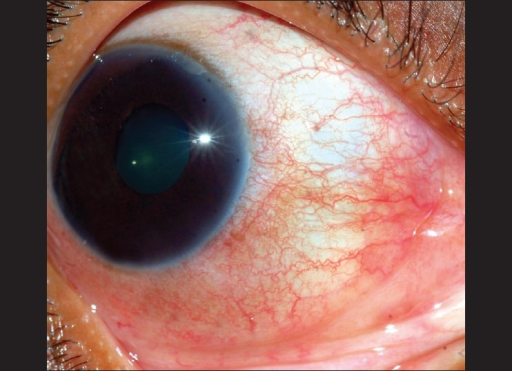 Descripción: Clinical examination revealed 7-mm probing depths, circumferentially around a mandibular implant, bleeding on probing, and the presence of exudate and gingival inflammatory edema