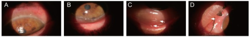 Descripción: Clinical examination revealed 7-mm probing depths, circumferentially around a mandibular implant, bleeding on probing, and the presence of exudate and gingival inflammatory edema