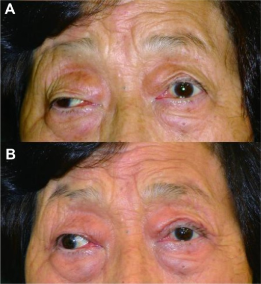 Descripción: Clinical examination revealed 7-mm probing depths, circumferentially around a mandibular implant, bleeding on probing, and the presence of exudate and gingival inflammatory edema