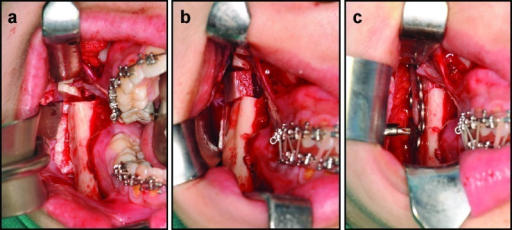 Descripción: Clinical examination revealed 7-mm probing depths, circumferentially around a mandibular implant, bleeding on probing, and the presence of exudate and gingival inflammatory edema