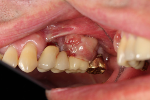 Descripción: Clinical examination revealed 7-mm probing depths, circumferentially around a mandibular implant, bleeding on probing, and the presence of exudate and gingival inflammatory edema