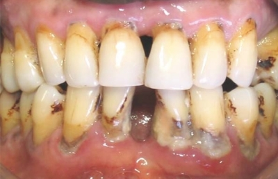 Descripción: Clinical examination revealed 7-mm probing depths, circumferentially around a mandibular implant, bleeding on probing, and the presence of exudate and gingival inflammatory edema