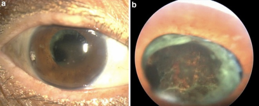 Descripción: Clinical examination revealed 7-mm probing depths, circumferentially around a mandibular implant, bleeding on probing, and the presence of exudate and gingival inflammatory edema