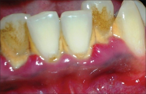 Descripción: Clinical examination revealed 7-mm probing depths, circumferentially around a mandibular implant, bleeding on probing, and the presence of exudate and gingival inflammatory edema