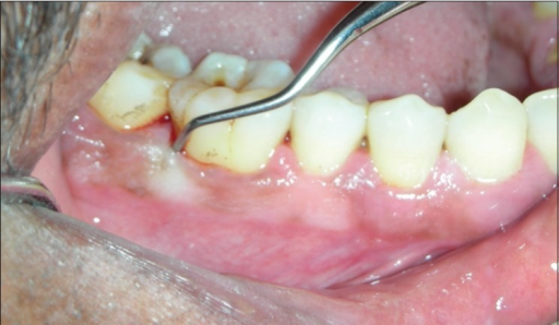 Descripción: Clinical examination revealed 7-mm probing depths, circumferentially around a mandibular implant, bleeding on probing, and the presence of exudate and gingival inflammatory edema