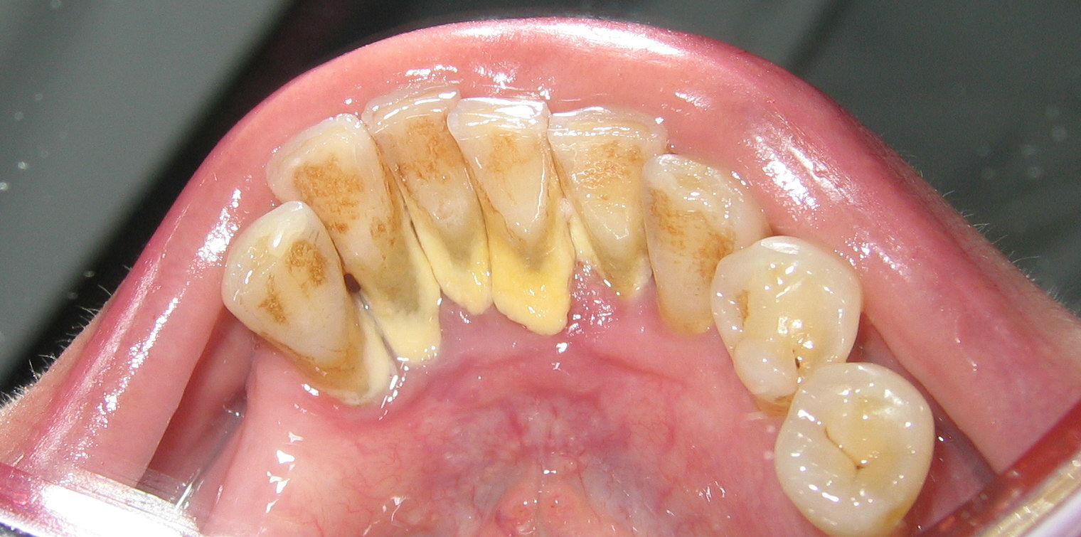 Descripción: Clinical examination revealed 7-mm probing depths, circumferentially around a mandibular implant, bleeding on probing, and the presence of exudate and gingival inflammatory edema